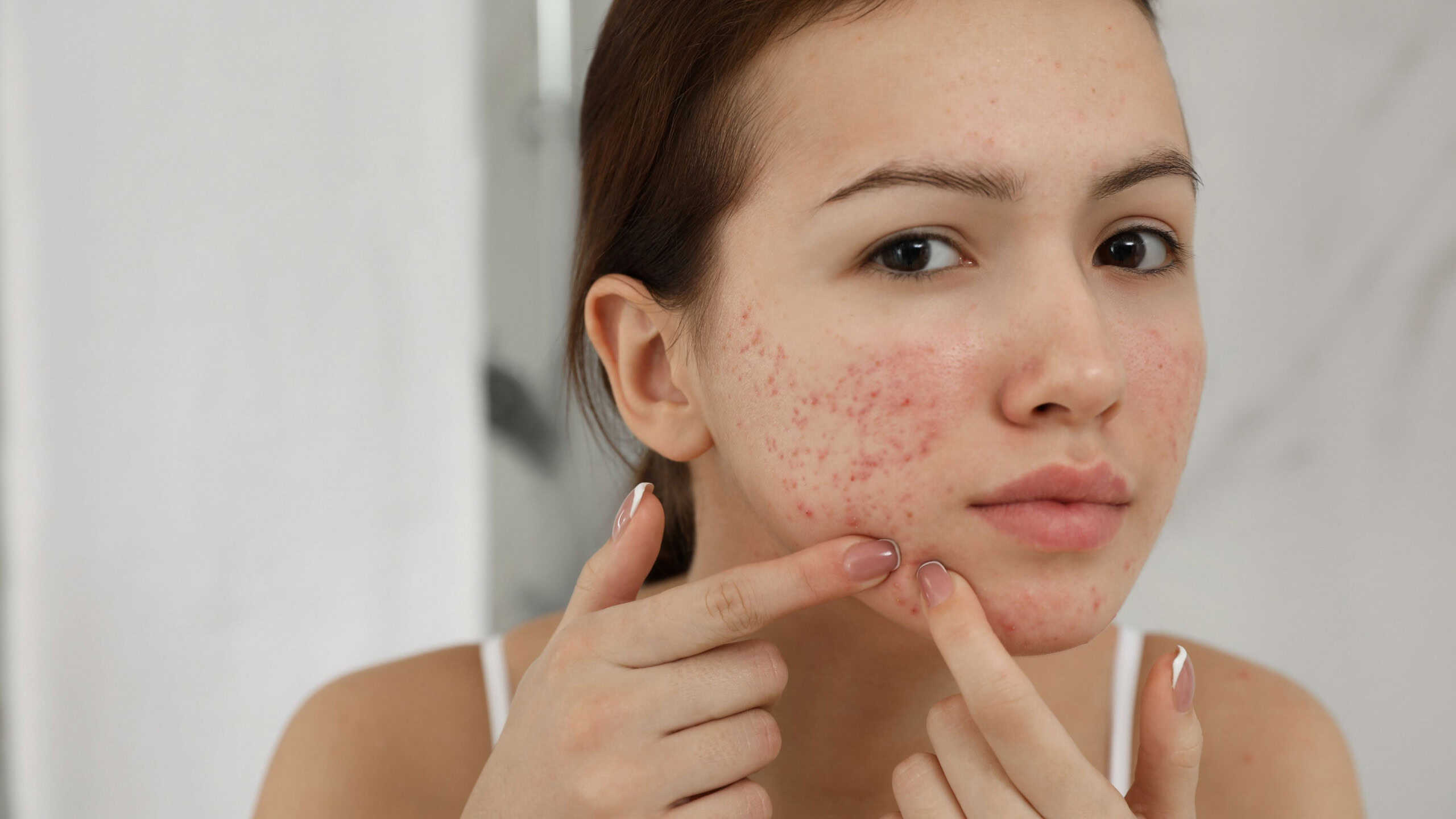 Pesquisadores avançam no desenvolvimento de vacinas contra a acne - Imagem do artigo