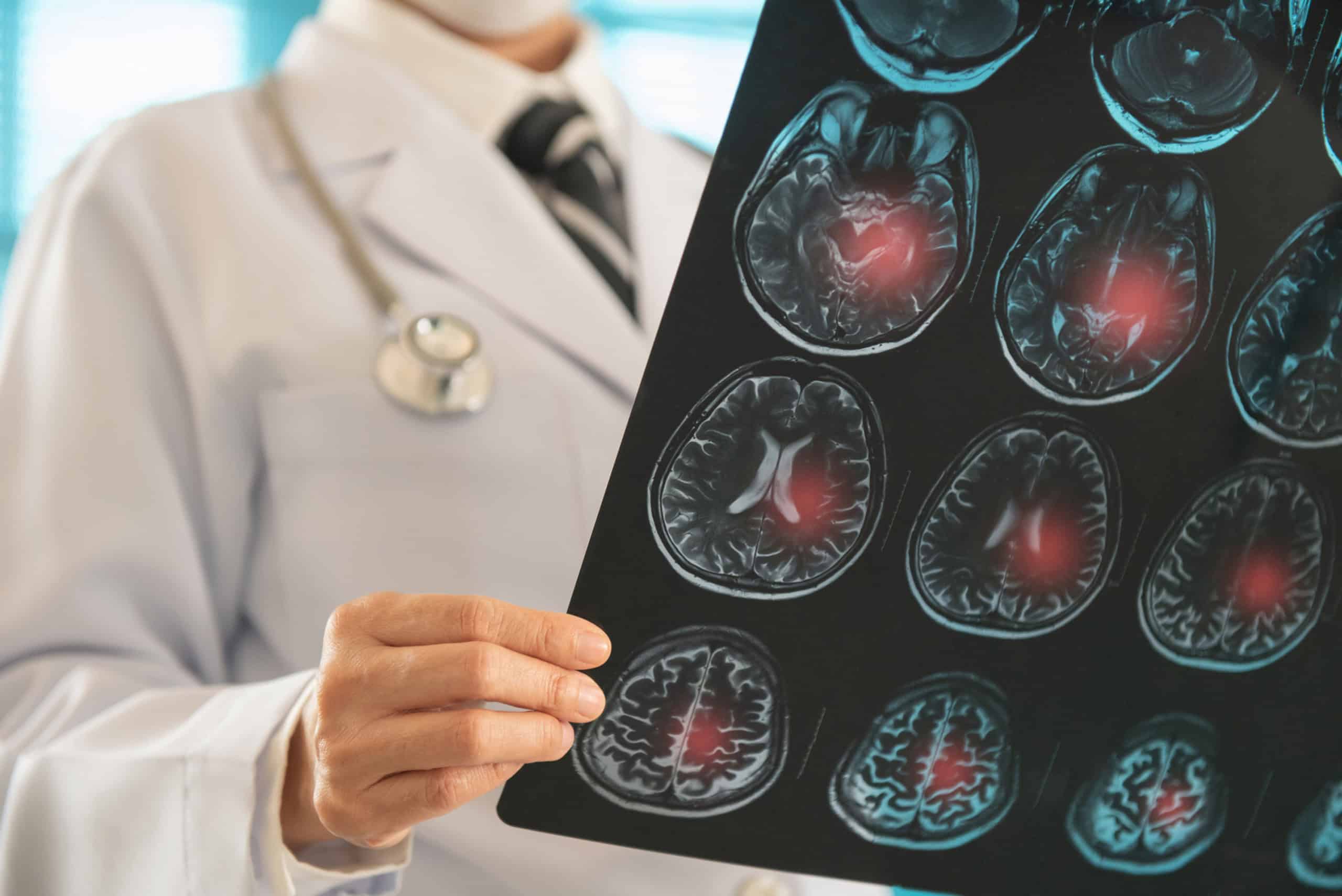AVC mata um brasileiro a cada seis minutos; oito em cada dez casos podem ser prevenidos - Imagem do artigo