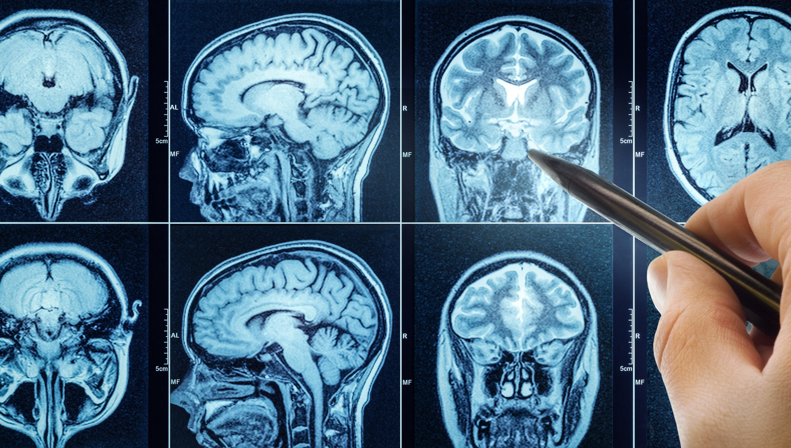 Antigo fármaco contra hipertensão mostra efeito inédito ao frear crescimento de tumor cerebral - Imagem do artigo