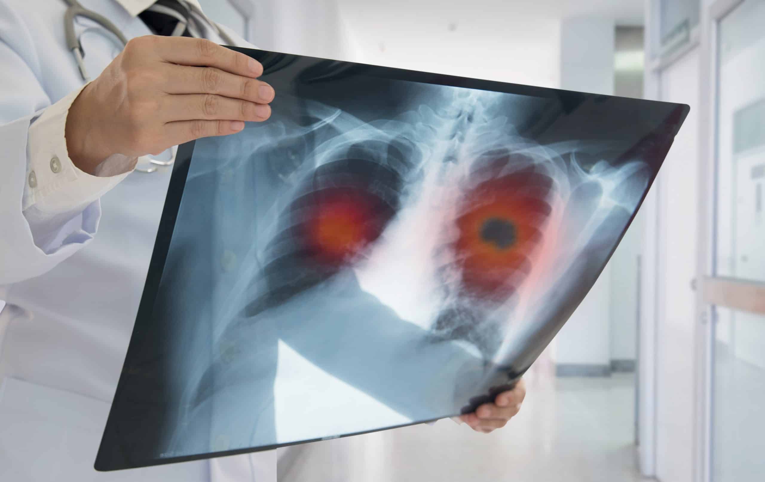 LungVax: vacina pioneira contra câncer de pulmão passará por testes em humanos - Imagem do artigo