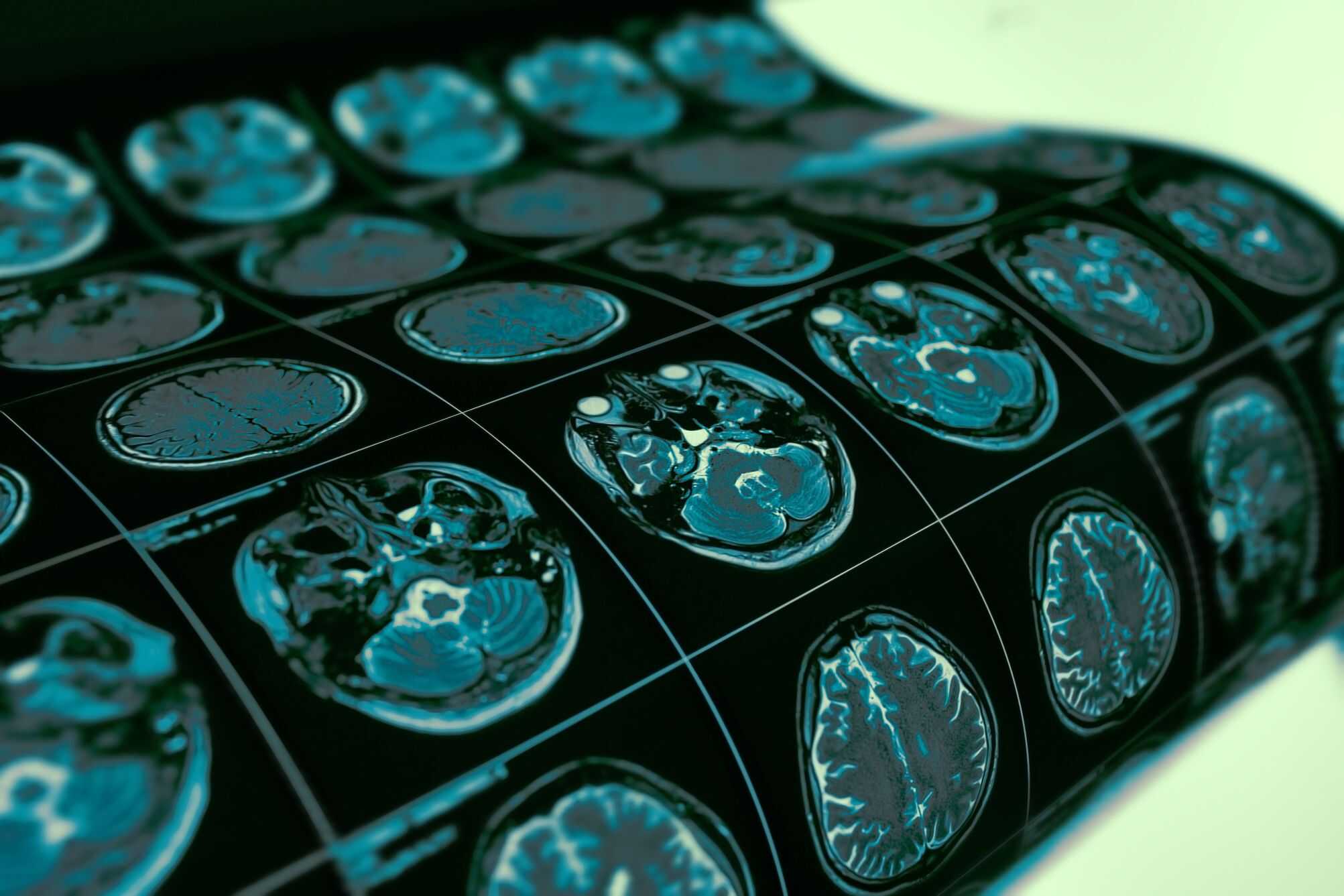 Mapeamento identifica focos iniciais de alterações cerebrais na esquizofrenia - Imagem do artigo